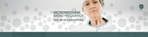 microneedling-radio-frequency-featured-image