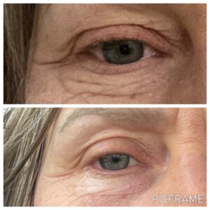 Co2 laser Eye lift before and after